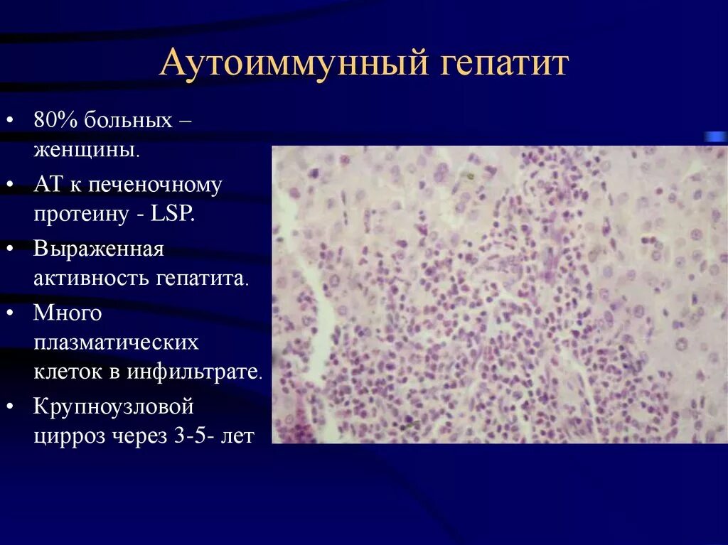 Гепатит альфа. Гепатит печени патанатомия. Патоморфология аутоиммунного гепатита. Аутоиммунный гепатит патанатомия. Аутоиммунный гепатит цирроз печени.