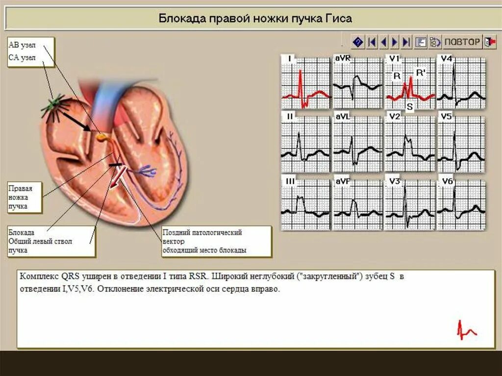 Блокада пучка гиса у подростка. Пучок Гиса в сердце блокада правой ножки. Блокада правой ножки пучка Гиса на ЭКГ. Кардиограмма сердца блокада правой ножки пучка Гиса. Патогенез блокады правой ножки пучка Гиса.