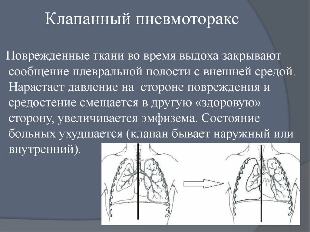 Напряженный пневмоторакс помощь. Клапанный пневмоторакс (нарастающий, напряженный). Клапанный пневмоторек. Клапанныйпневматоракс. Клапанный спонтанный пневмоторакс.