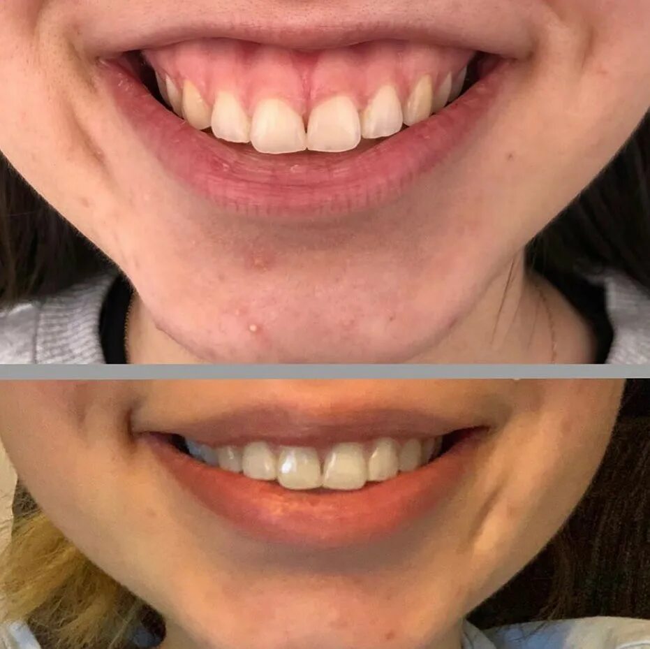 Коррекция smile clinicaspectr ru. Пластика уздечки десневая улыбка. Пластика уздечки верхней губы десневая улыбка. Исправление десновидной улыбки. Коррекция десневой улыбки.