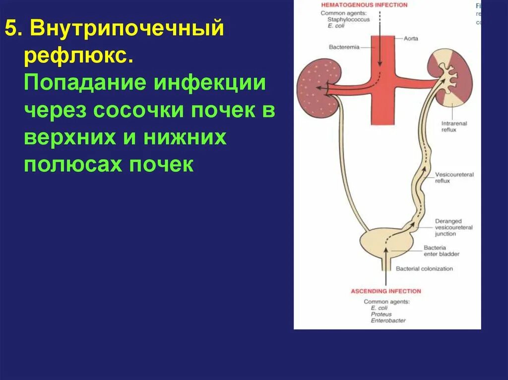 Рефлюкс мочеточника. Патогенез рефлюкс нефропатии. Внутрипочечный рефлюкс.