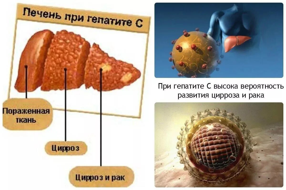 Что за болезнь гепатит. Вирусные болезни печени (гепатит).. Печень при вирусном гепатите. Гепатит вирусное заболевание.