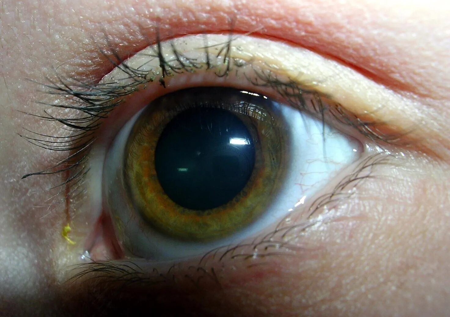 Поит глаз. Неоваскулярная глаукома.