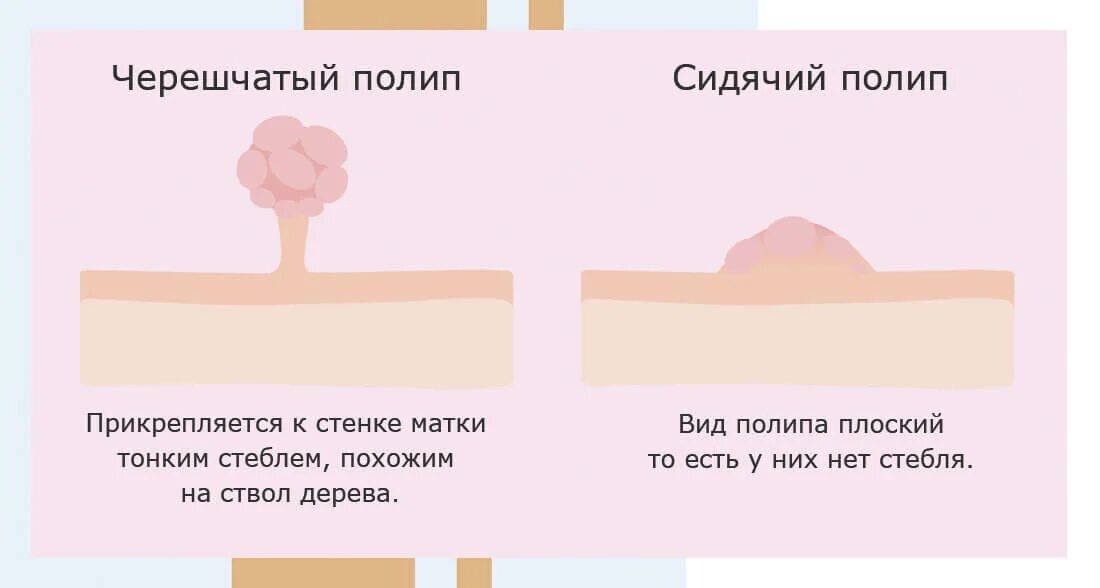 Классификация полипов эндометрия. Причины образования полипов. Полипы шейки матки классификация.