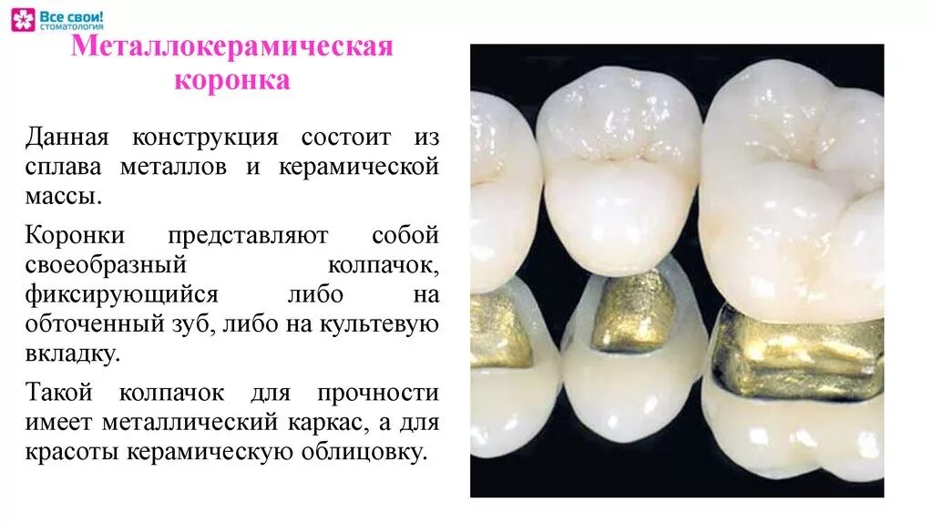 Конструктивные элементы металлокерамической коронки.. Толщина каркаса металлокерамической коронки (в мм). Металлокерамическая коронка Элит. Коронка металлокерамическая (каркас КХС).