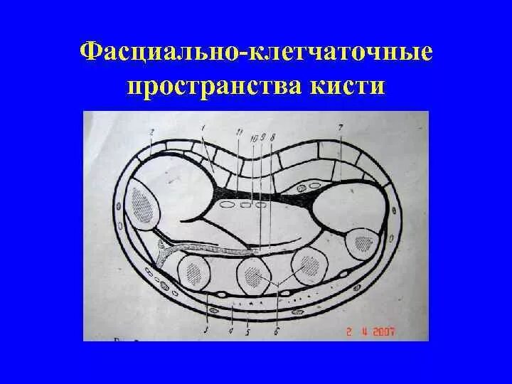 Среднее фасциальное ложе ладони. Фасциальные ложа ладони кисти. На ладони выделяют фасциальные ложа. На ладони выделяют фасциальные ложа. Фасциальные ложа кисти схема.