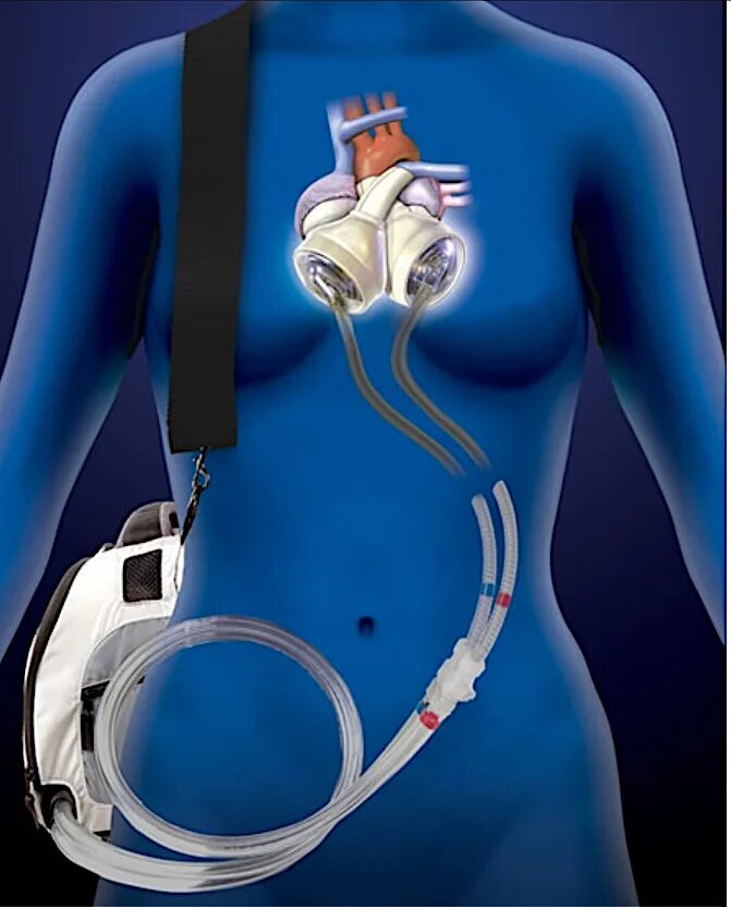 искусственное сердце abiocor (2001). искусственное сердце abiocor (2001). макет искусственного сердца. как сделать искусственное сердце. автономное искусственное сердце.