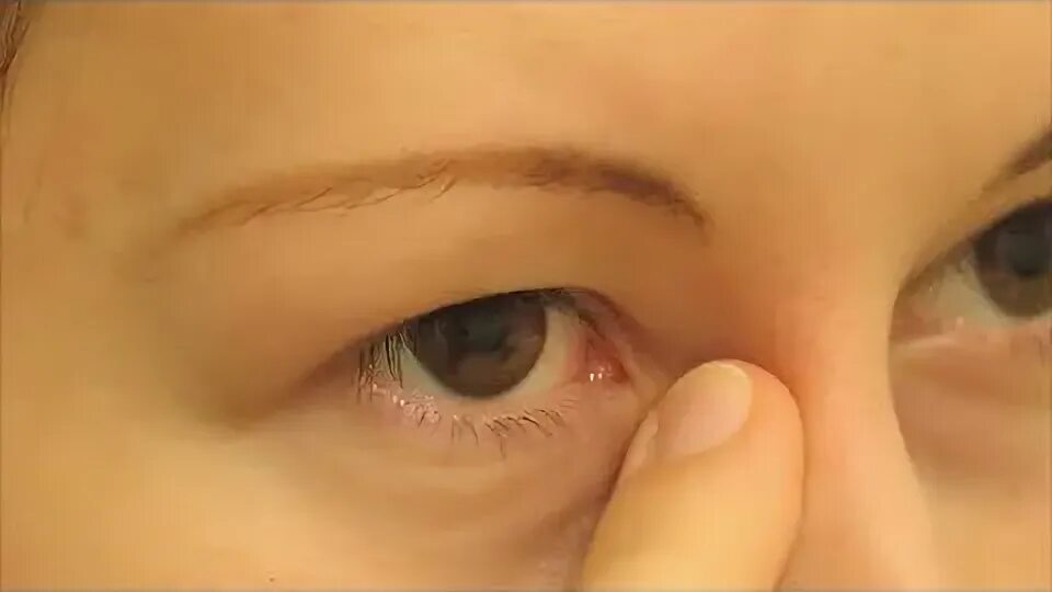 Массаж глаз слезного канала. Атерома слезного мешочка. Дакриоцистит новорожденных дакриоцистит.