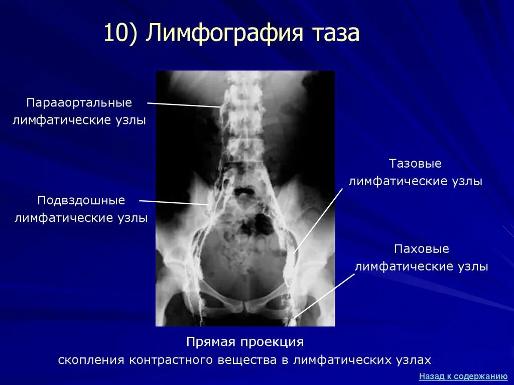 Паракостпльные лимфатические узлы. Паракруральные лимфатические узлы. Парааортальные лимфатические узлы. Подвздошные лимфатические узлы. Тазовая лимфаденопатия