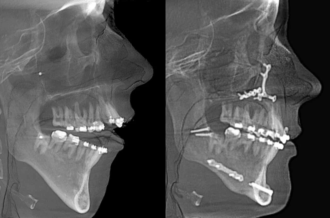 кт суставов челюсти внчс. кт в окклюзии. магнитно-резонансная томография височно-нижнечелюстного сустава. кт в окклюзии. кт томография челюсти сустава внчс.