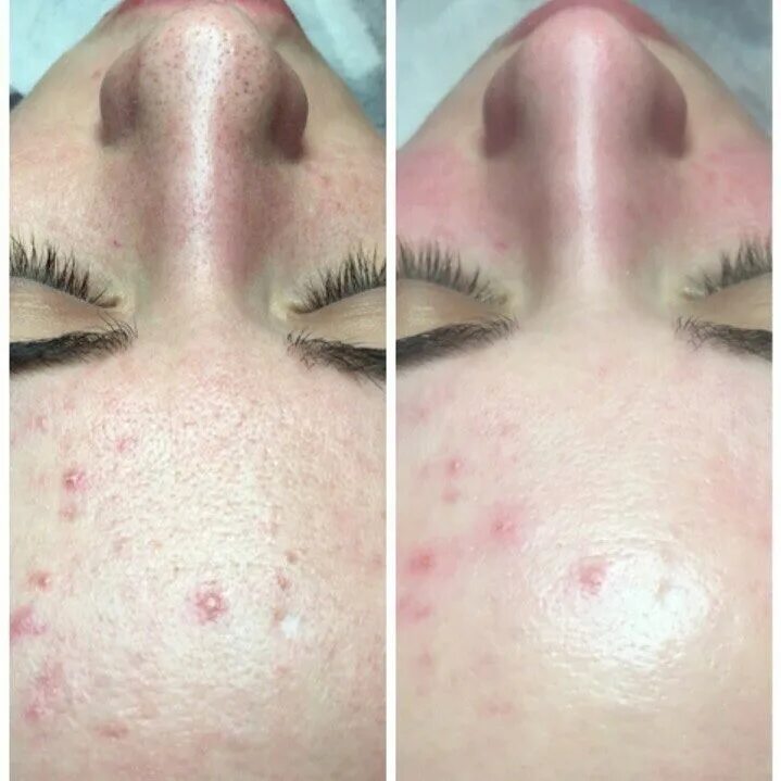 черные точки косметолог. черные точки косметолог. черные точки косметолог. ультразвуковая и комбинированная чистка лица. черные точки косметолог.