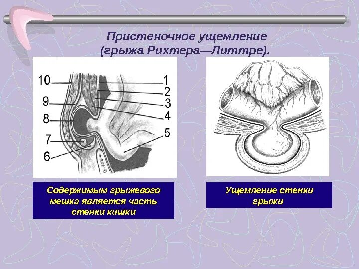 Грыжа Литтре (ущемление дивертикула Меккеля в паховой грыже). Ущемление Меккелева дивертикула грыжа Литтре. Пристеночное ущемление (грыжа Рихтера).