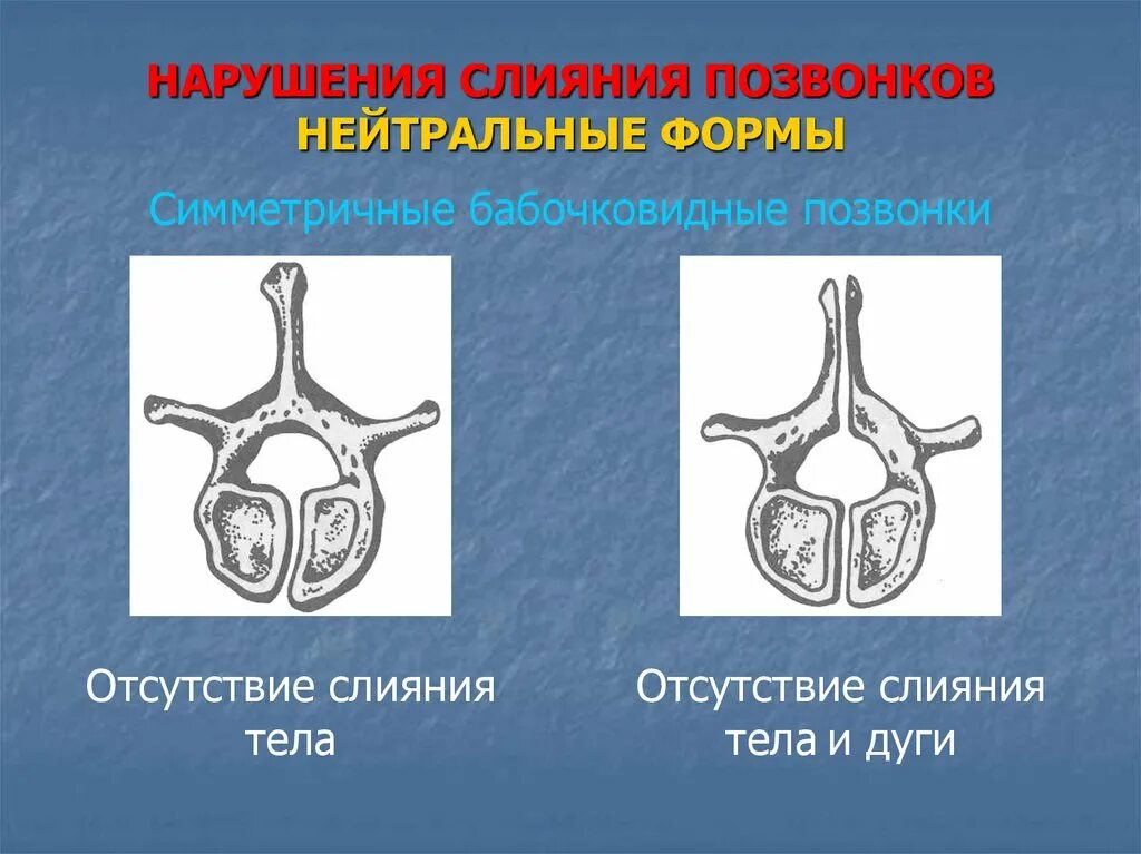 Аномалии развития позвоночника. Бабочковидные позвонки. Аномалии развития позвонков. Аномалии развития поясничного отдела позвоночника. Аномалия развития позвонков грудного отдела.