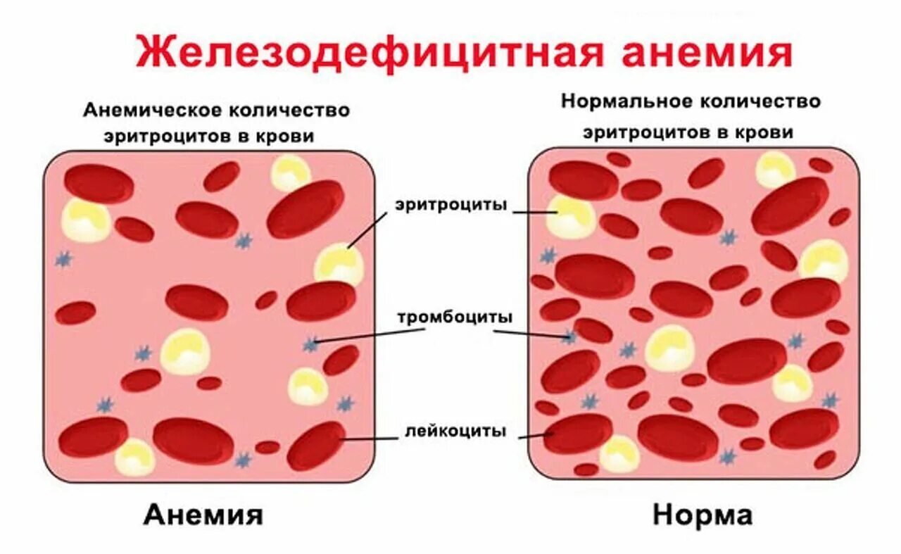 Кис крови. Железная дефицитная анемия. Эритроциты при железодефицитной анемии у детей. Эритроциты при железодефицитной анемии. Основные симптомы при железодефицитной анемии.