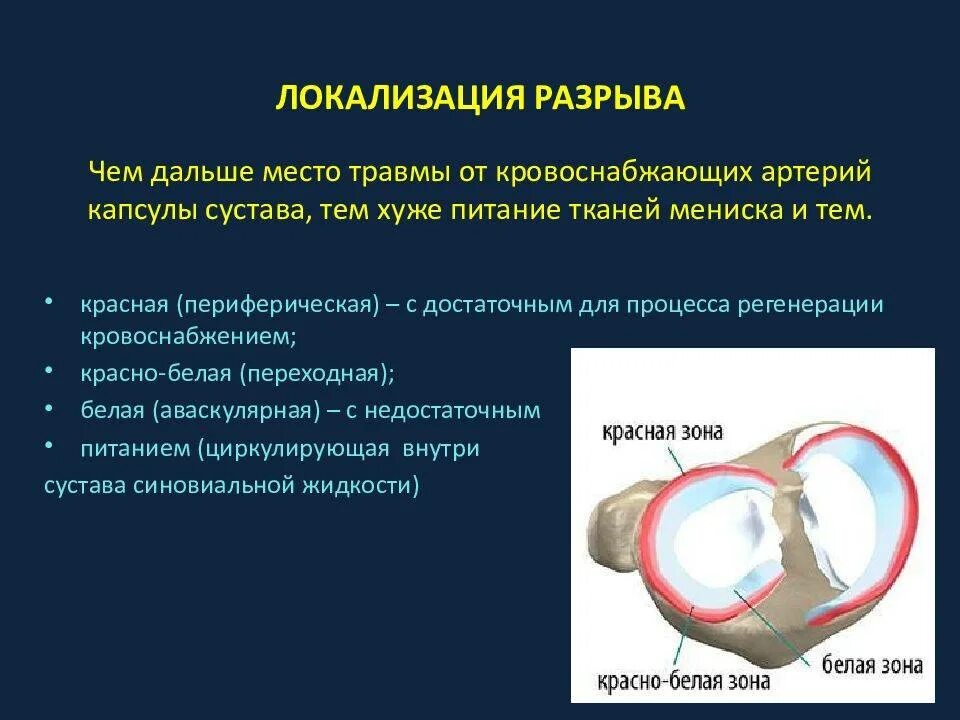 Повреждение мениска коленного сустава классификация. Повреждение минискаколенного сустава. Разрыв мениска коленного сустава. Повреждение мениска коленного сустава симптомы. Мениск коленного сустава лечение в домашних