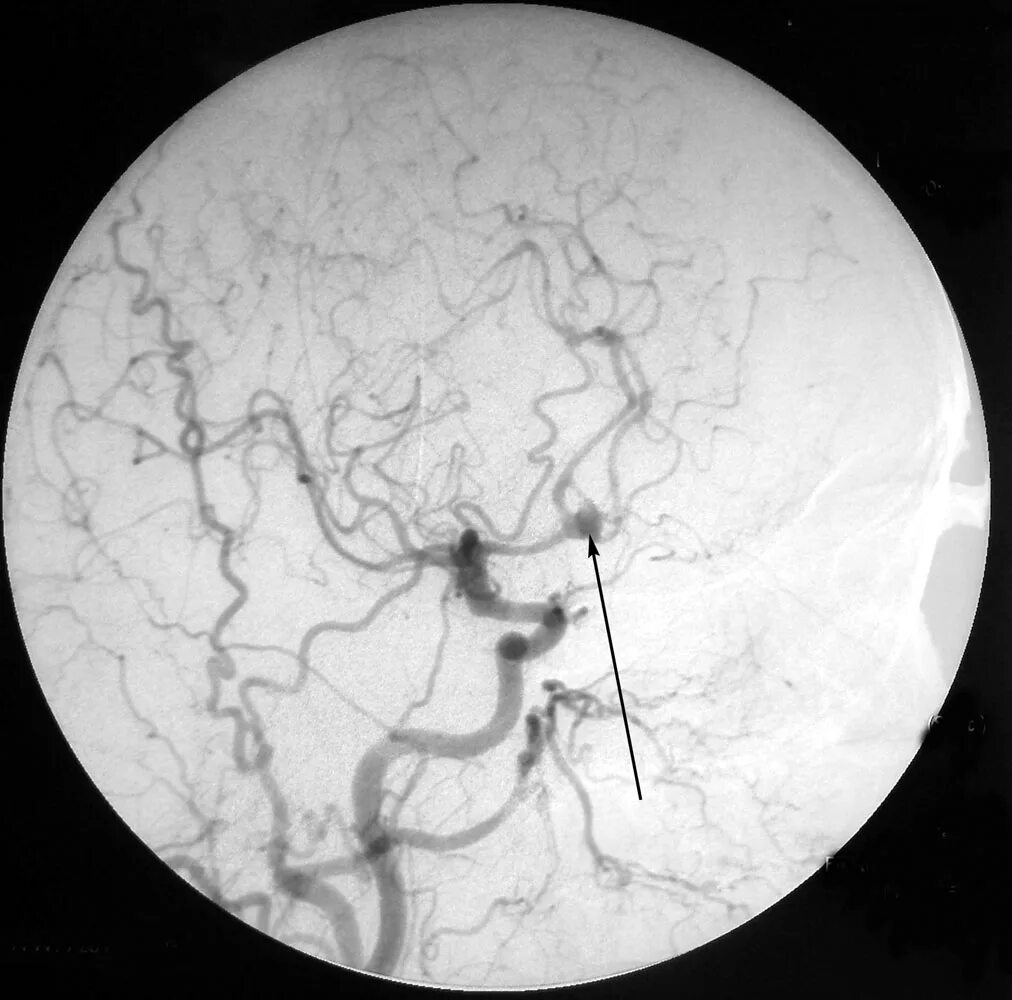 Аневризма артерии головного мозга. Аневризма сосудов что это такое симптомы. Аневризма среднемозговой артерии. Ангиография головного мозга аневризма.