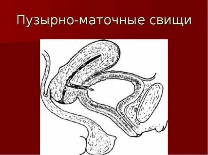 Влагалищный свищ