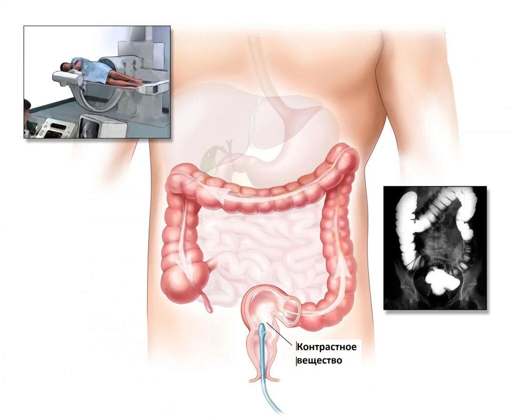 Ирригоскопия Толстого кишечника. Рентгеноскопия это Толстого и тонкого кишечника. Рентгенологическое исследование Толстого кишечника (ирригоскопия).. Ирригоскопия Толстого кишечника рентген. Стомы инвалидность