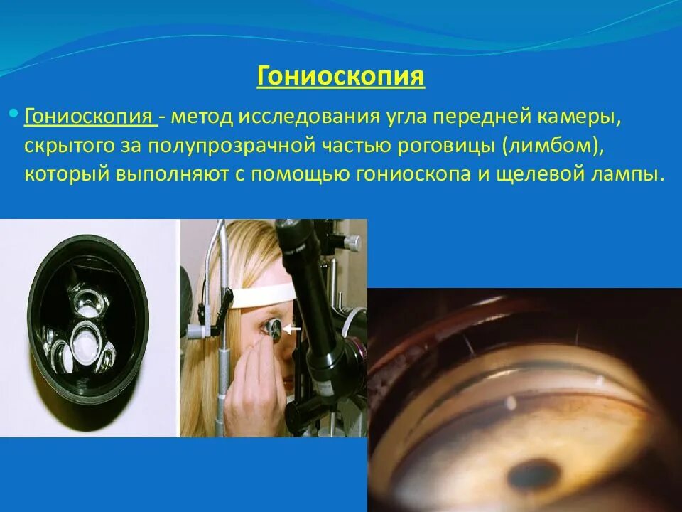 Гониоскопия это. Линза краснова гониоскоп. метод исследования угла передней камеры. гониоскопия что это такое в офтальмологии. гониоскопия - исследование угла передней камеры.