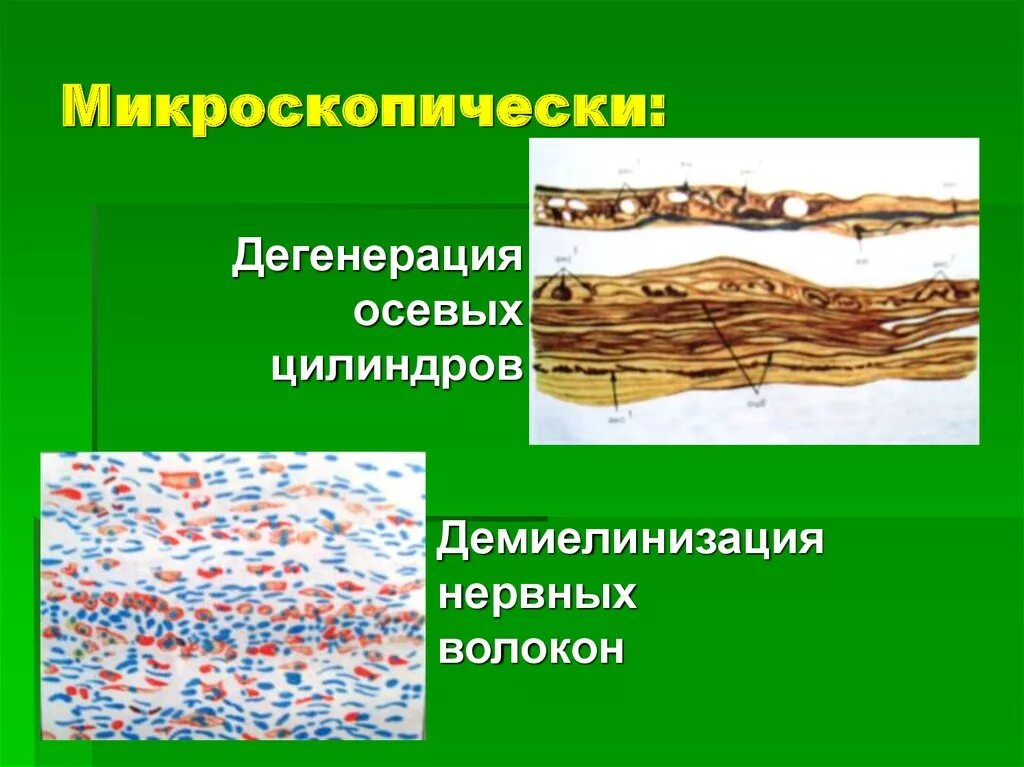 Дегенерация головного. Дегенерация нервных волокон. Демиелинизация нервных волокон. Демиелинизация нервных волокон гистология. Демиелинизация гистология.