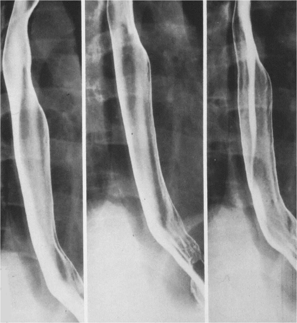 Пищевода с барием. Скопия пищевода рентген. Контрастирование пищевода рентген. Аномалии пищевода рентген. Стриктура пищевода рентген.