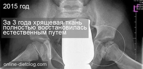 Восстановление хрящевого сустава