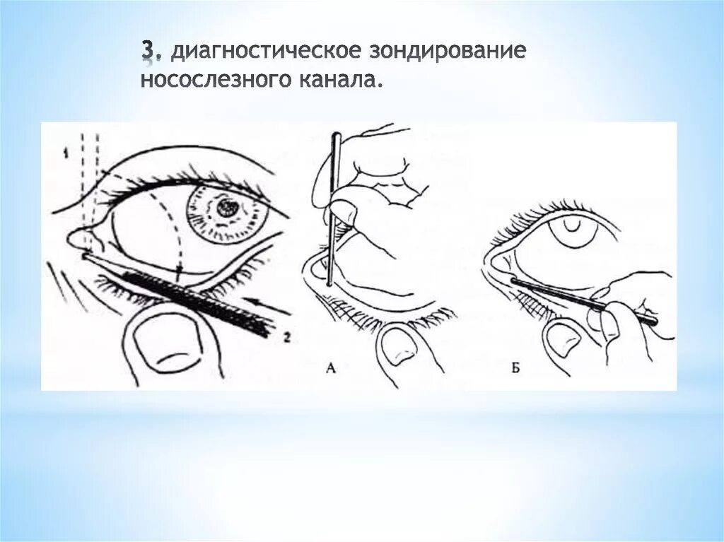 Лечить слезный канал. Непроходимость слезных путей операция. Зондирование слезного канальца. Операция на хронический дакриоцистит. Закупорка слезного слезной железы.