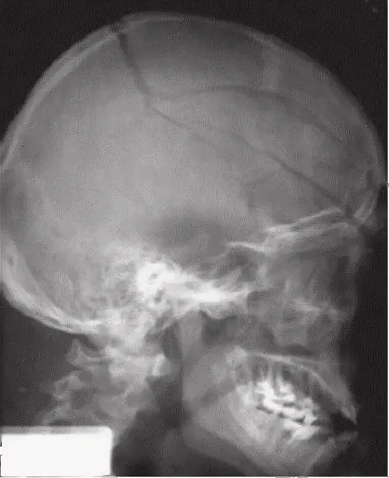 Трещина в голове. Оскольчатый перелом черепа рентген. Перелом теменной кости черепа рентген. Перелом теменной кости рентген. Перелом костей черепа рентген.