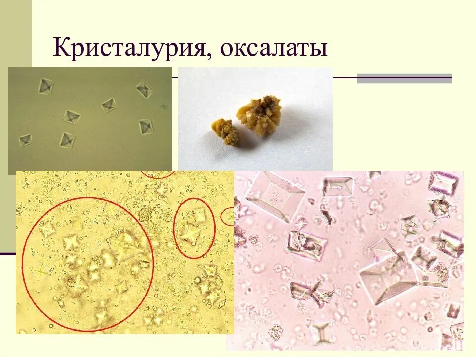 Оксалат кальция в моче повышен. Оксалаты микроскопия мочи. Струвиты микроскопия. Струвиты и оксалаты под микроскопом. Оксалат кальция под микроскопом.