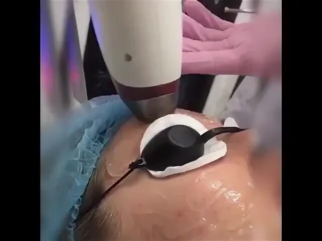 Диодное омоложение лазером. Омоложение диодным лазером. диодное лазерное омоложение. лазерное омоложение на диодном лазере. лазерное неабляционное омоложение на диодном лазере.