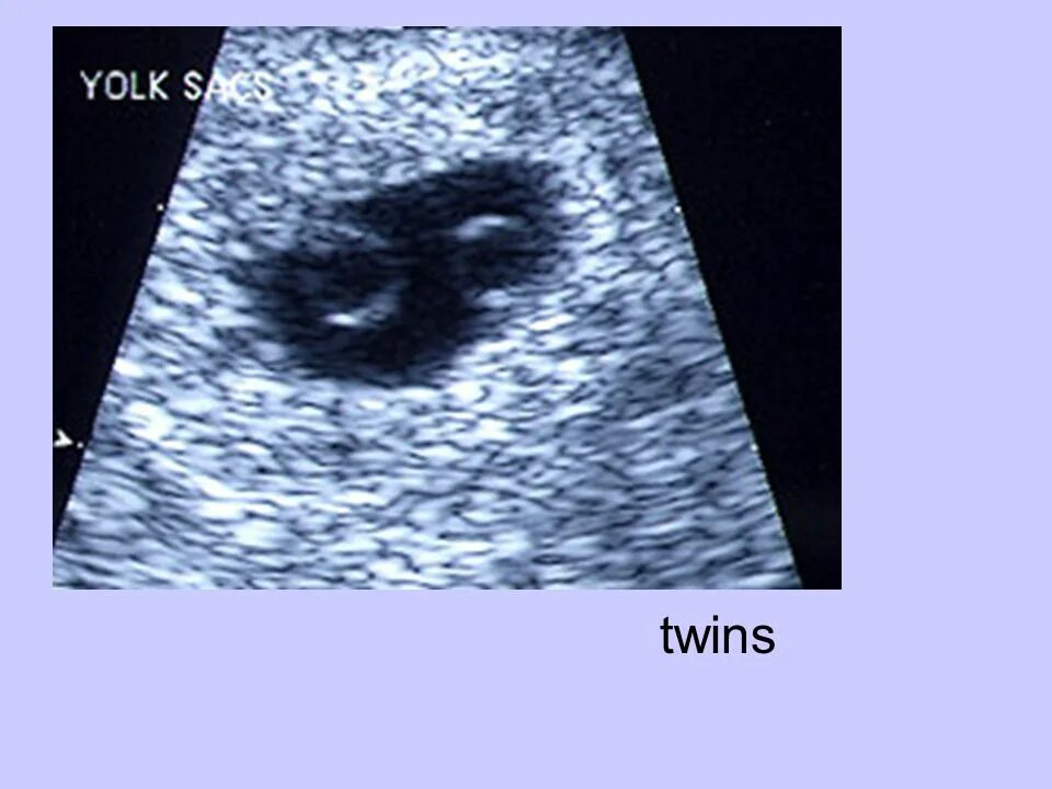 УЗИ многоплодной беременности 5 недель. УЗИ однояйцевые двойни 5 недель беременности. УЗИ 6 недель беременности двойня однояйцевые. УЗИ 5 недель беременности двойня однояйцевая.