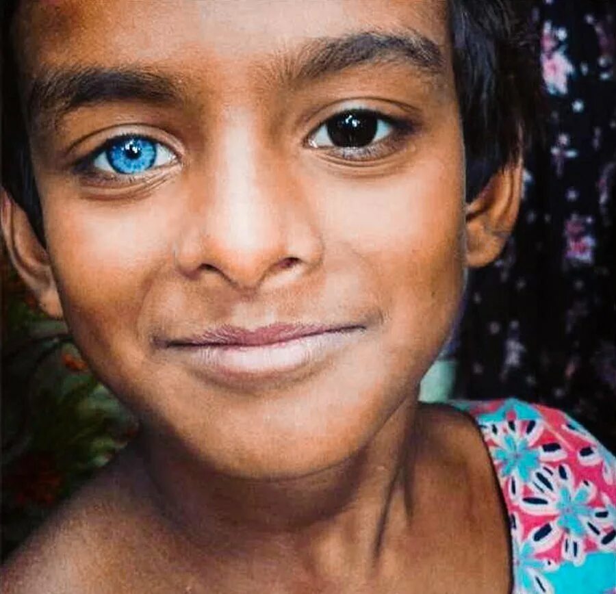 Синдром Ваарденбурга Эстетика. Тайцы раса. Необычные глаза. Необычный цвет глаз. Different eye