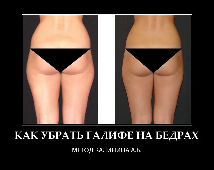 Почему галифе такой формы. Галифе на бедрах. как убрать галифе на бедрах. убрать зону галифе. галифе это жир.