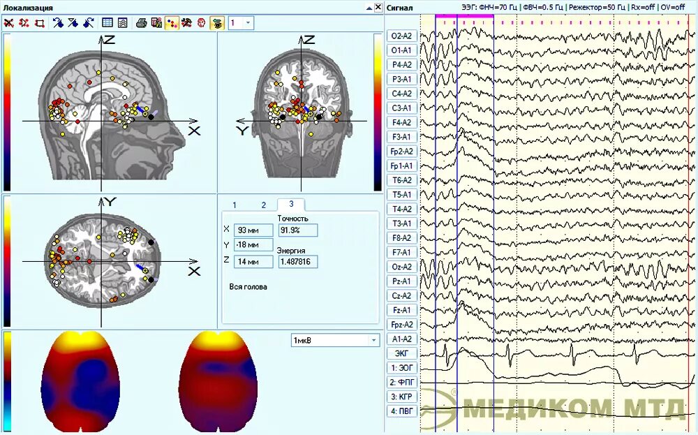 Чем отличается ээг от. ЭЭГ Энцефалан 131-03 модель 08 пробы. Артефакт ЭКГ на ЭЭГ. ЭЭГ (электроэнцефалограмма) головного мозга. Электродные артефакты на ЭЭГ.