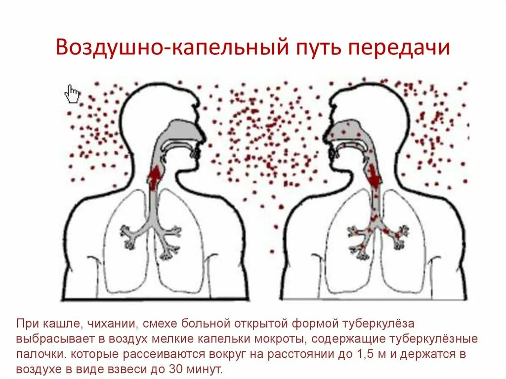 Воздушно-капельный путь передачи инфекции. Воздушно капельный путь заражения. Воздушно капельный путь передачи туберкулеза. Воздушно капельный путь заражения туберкулезом.