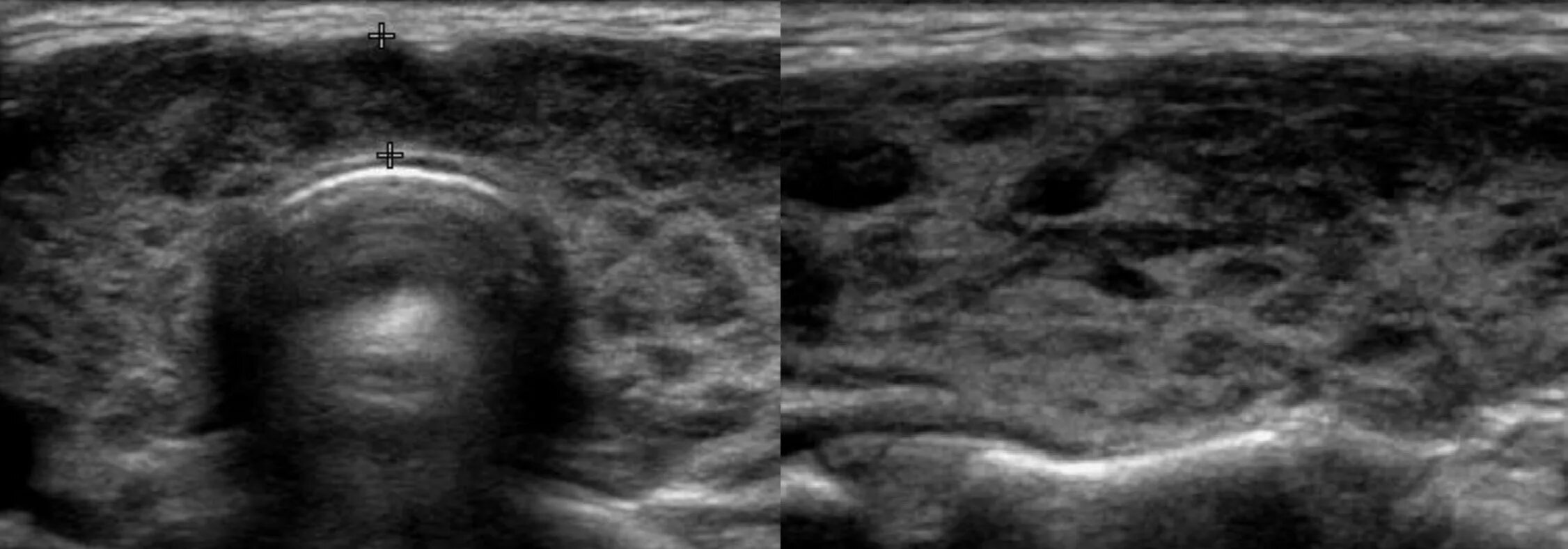 Диффузно Узловой зоб УЗИ. АИТ на УЗИ щитовидной железы. Хронический аутоиммунный тиреоидит щитовидной железы УЗИ. Аутоиммунный тиреоидит УЗИ картина.