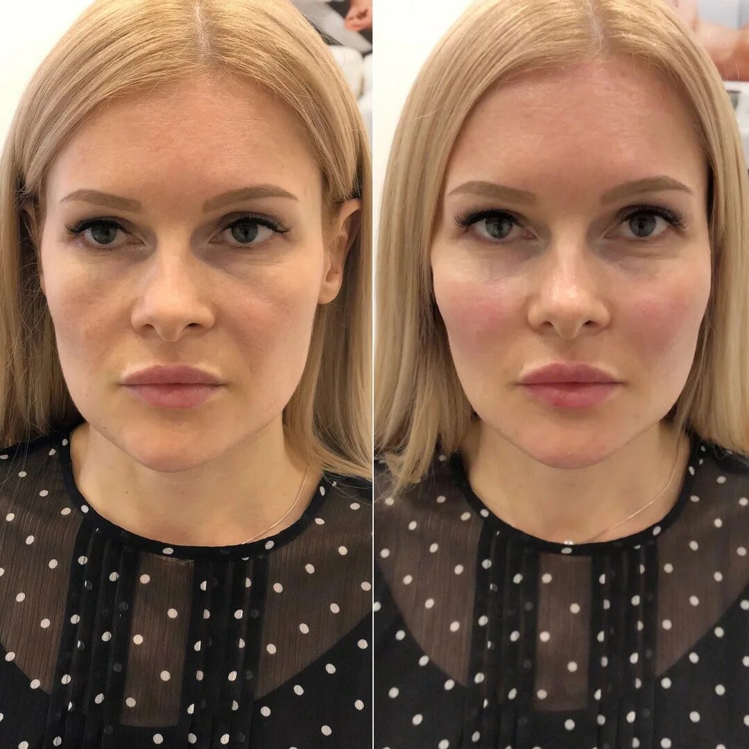 Фулл фейс что это. Диспорт фулфейс. ботокс full face до и после. филлеры для лица.