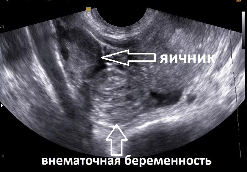 Узи после лечения. Внематочная Трубная беременность УЗИ. Маточная и внематочная беременность УЗИ. Внематочная беременность на УЗИ. Внематочная беременность 5-6 недель УЗИ.