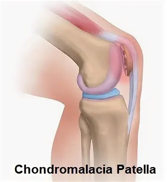 Хондромаляция медиальных мыщелков 4. Хондромаляция надколенника 4 степени. Хондромаляция хряща колена. Хондромаляция надколенника Outerbridge. Хондромаляция 2 степени коленного сустава.