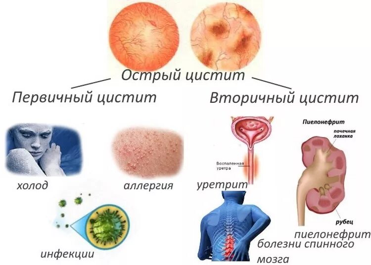 Сколько дней лечится цистит. Цистит это инфекционное заболевание. Инфекция мочевой системы (острый цистит,. Первичные симптомы цистита. Первичный и вторичный цистит.