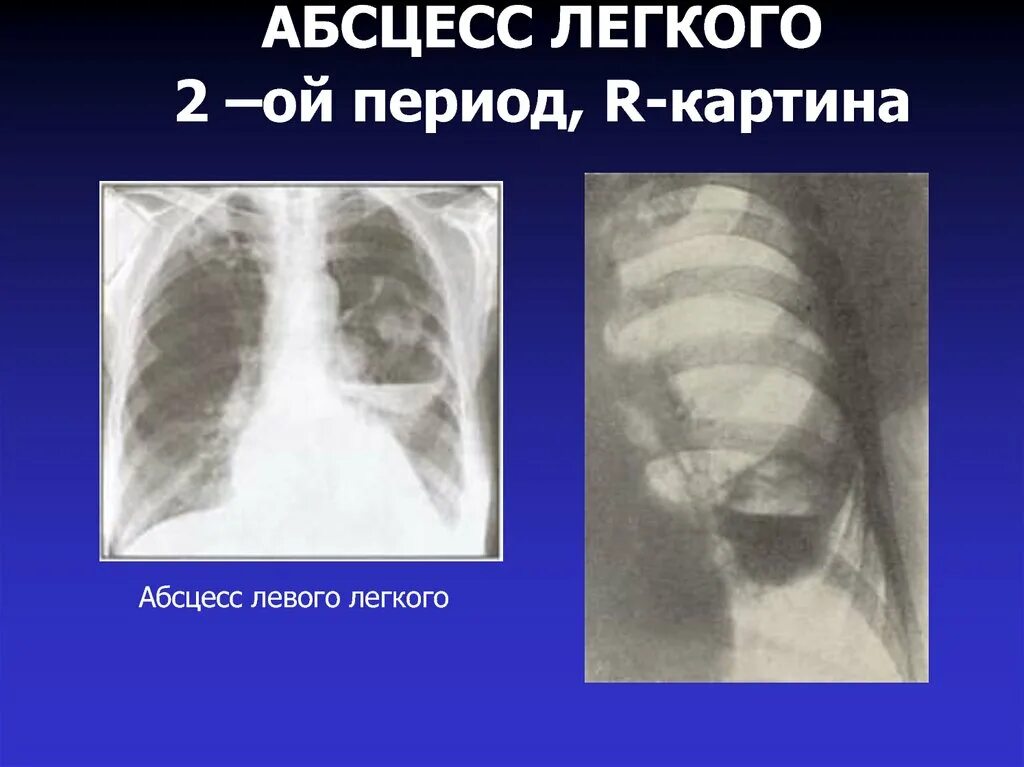 Абсцесс легкого мкб. Поддиафрагмальный абсцесс кт. Периоды абсцесса легкого. 2 Период абсцесса легкого. Рентгенограмма поддиафрагмального абсцесса.