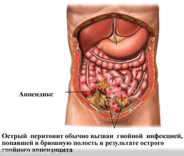 Где находится придатки у женщины фото. Острый аппендицит спеританитом.