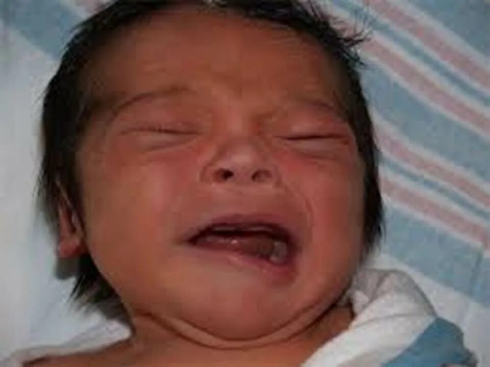 Порез лицевого. Парез лицевого нерва у новорожденных. Центральный парез лицевого нерва у новорожденных. Родовая травма парез лицевого нерва. Невропатия лицевого нерва у новорожденных.