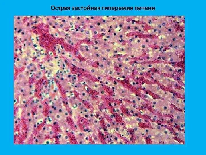 Печень при хроническом венозном застое. Венозное полнокровие печени мускатная печень. Венозное полнокровие патанатомия. Хроническое венозное полнокровие печени препарат.