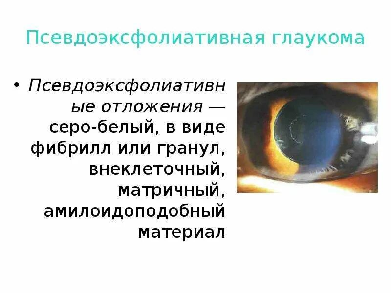 Псевдоэксфолиативный синдром глаза что это такое