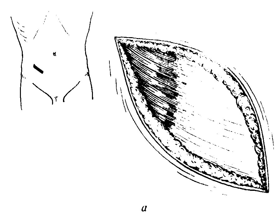 Какое лапаротомия. Нижнесрединная лапаротомия разрез. Косые разрезы лапаротомия.