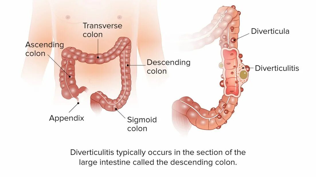Дивертикулит и дивертикулез. Острый дивертикулит толстой кишки. Дивертикулит Толстого кишечника колоноскопия. Дивертикулит сигмовидной кишки. Дивертикулез сигмовидной кишки диета лечение