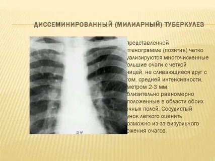 Исход милиарного туберкулеза легких