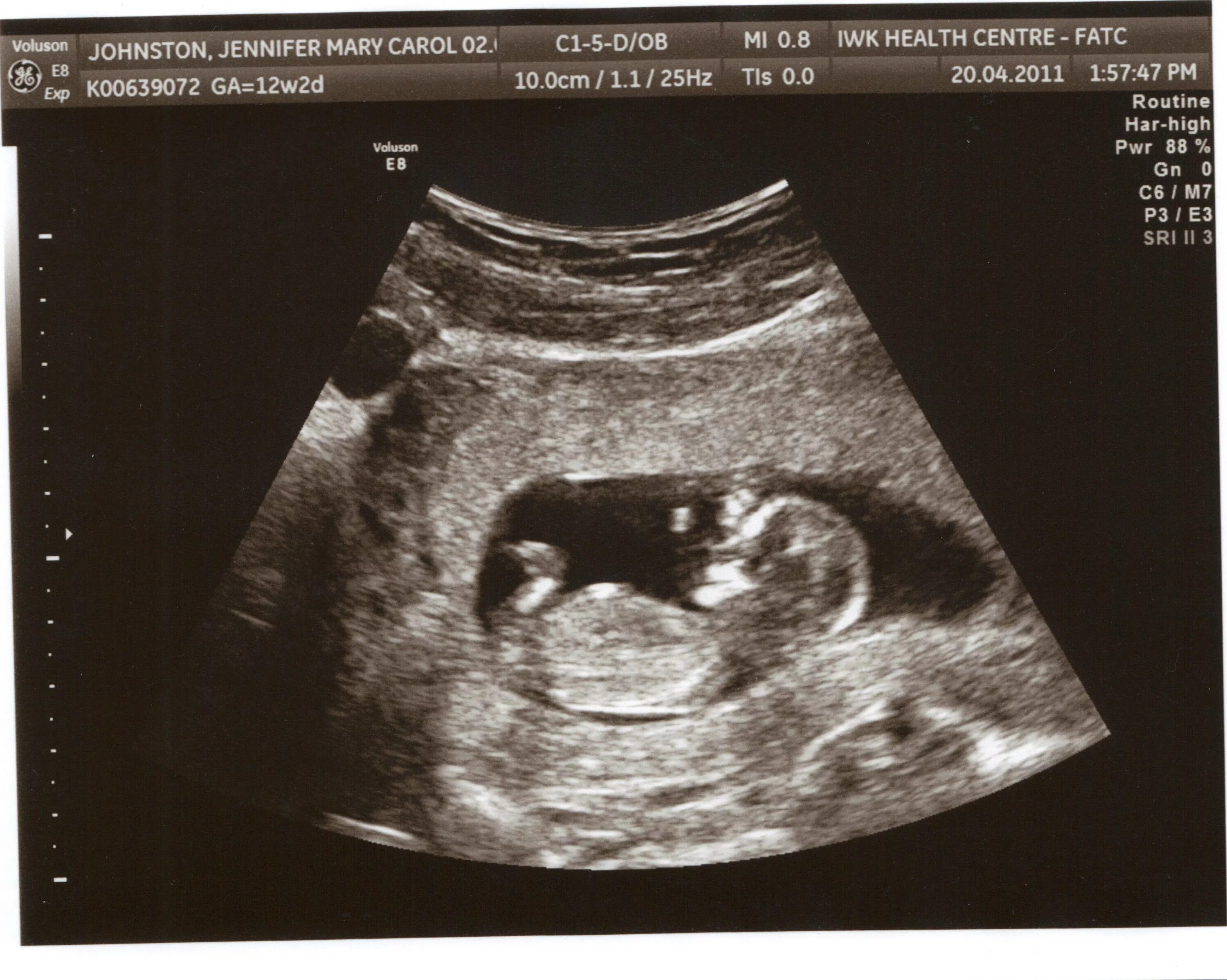 12 Недель беременности фото ребенка плода на УЗИ. Снимок УЗИ на 12 неделе беременности. УЗИ на 12 неделе беременности фото плода на УЗИ. Эмбрион на 12 неделе беременности УЗИ.