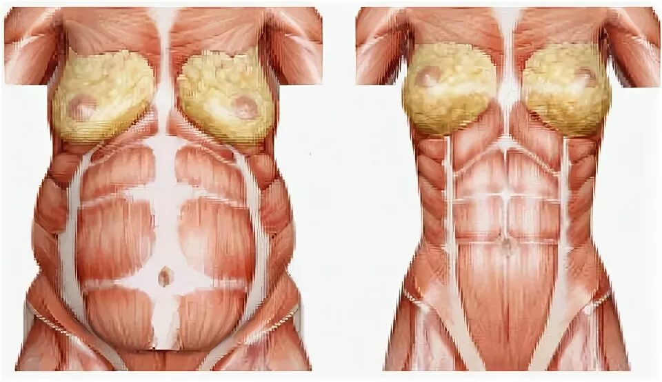 Прямые мышцы живота у мужчин. Диастаз брюшной полости. Диастаз мышц брюшного пресса. Диастаз белой линии живота.